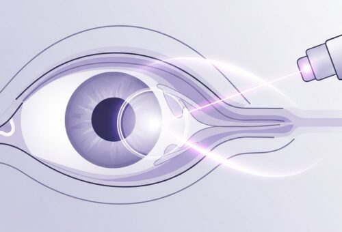 Brief Guide to CPT Code 66821